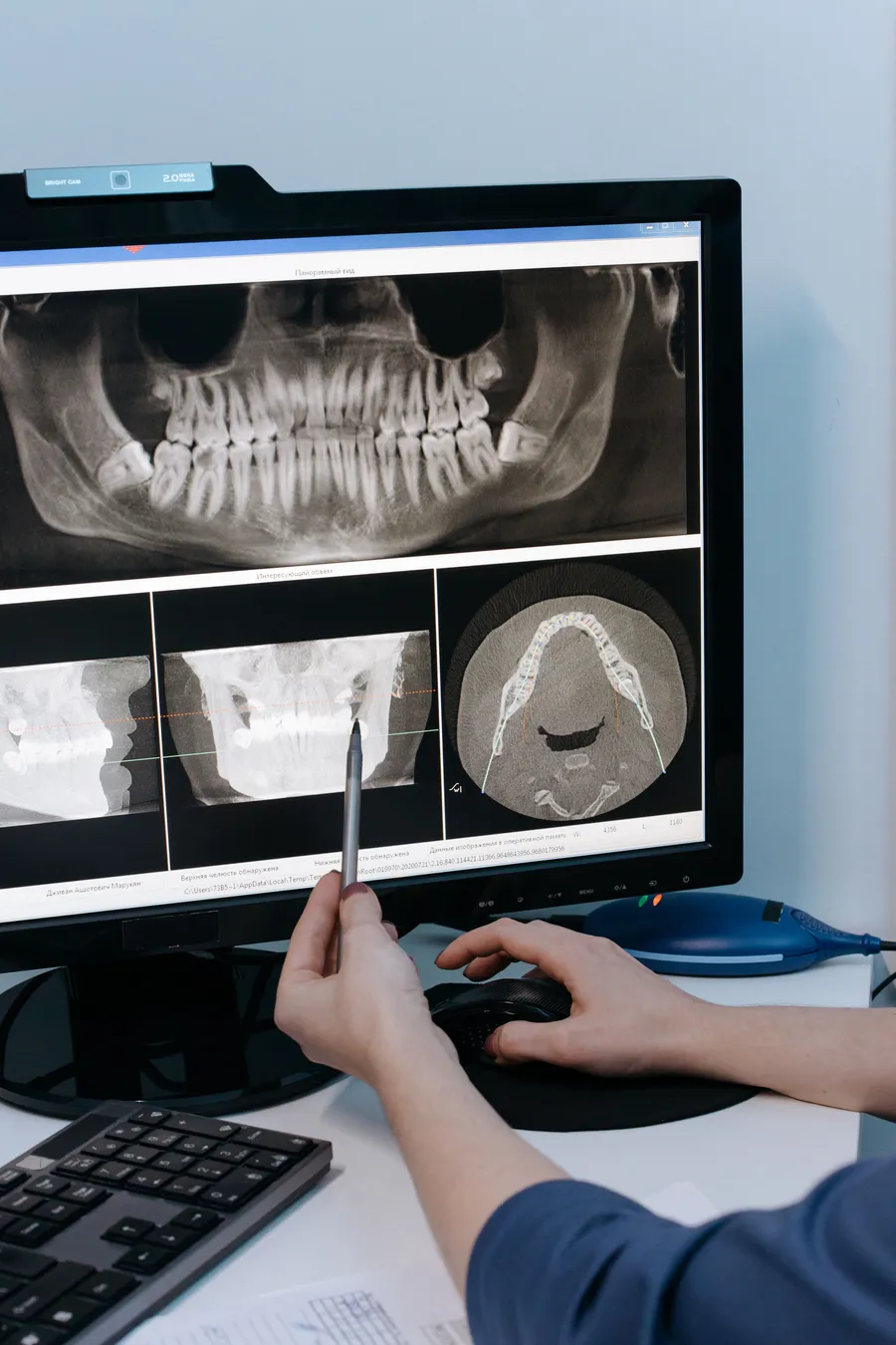 Digital scan used to plan a dental implant
